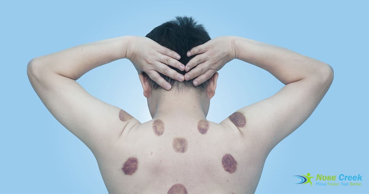 What Exactly Is Cupping Therapy Anyway Nose Creek Physiotherapy